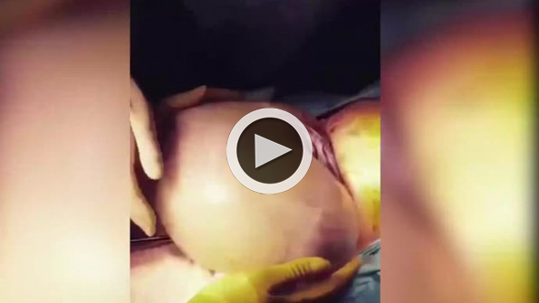80 binde bir görülen olay: Bebek, amniyon kesesiyle birlikte doğdu