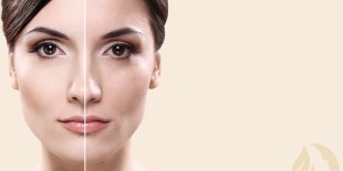 Karbon Peeling Nedir?