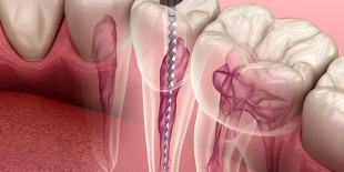 Kanal Tedavisi Nedir